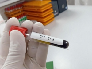 ANTIGENO CARCINOEMBRIONARIO